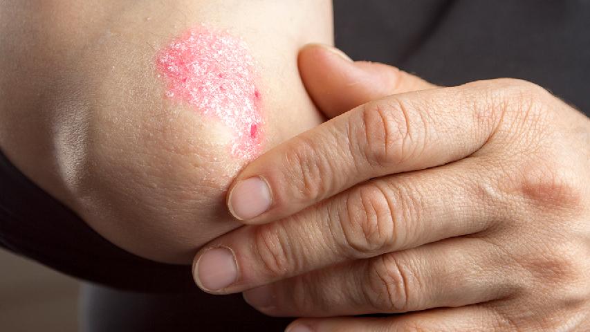 儿童银屑病预防介绍