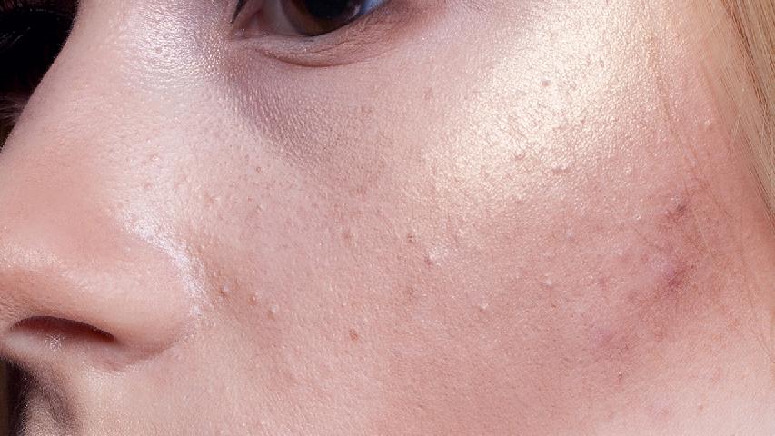 女性黃褐斑如何按摩