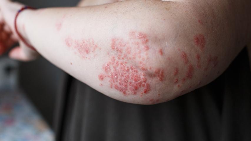 腳上長牛皮癬用什么藥可以治療？