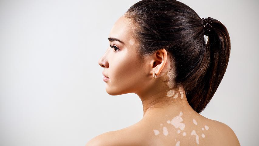 女性不同阶段白癜风症状