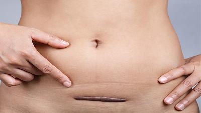 脸上有黄褐斑了怎么办