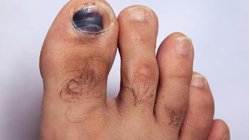 黄褐斑激光治疗优点