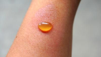 黄褐斑缓减的方法有哪些？