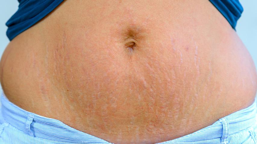 祛黄褐斑有效的方法