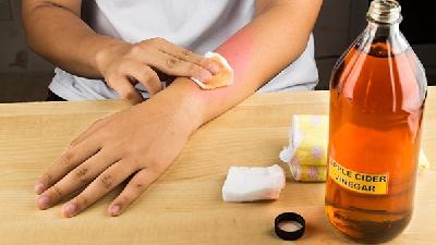 黄褐斑超好治 选对方法是关键