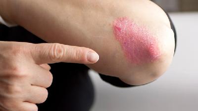 女性红皮病型银屑病预防怎么做