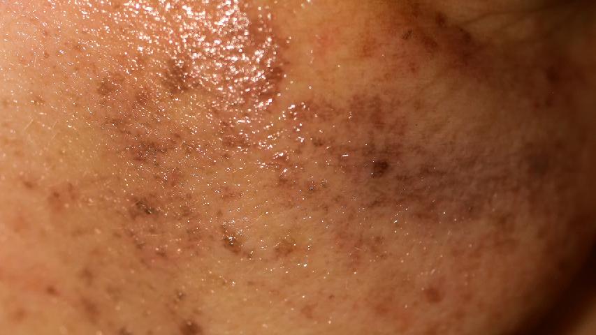 黄褐斑能点吗？治疗方法有哪些？