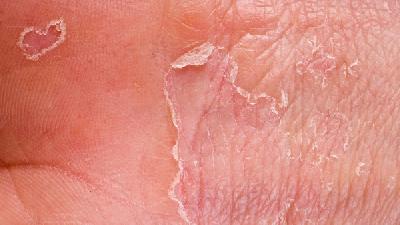 痤疮的症状有哪些？