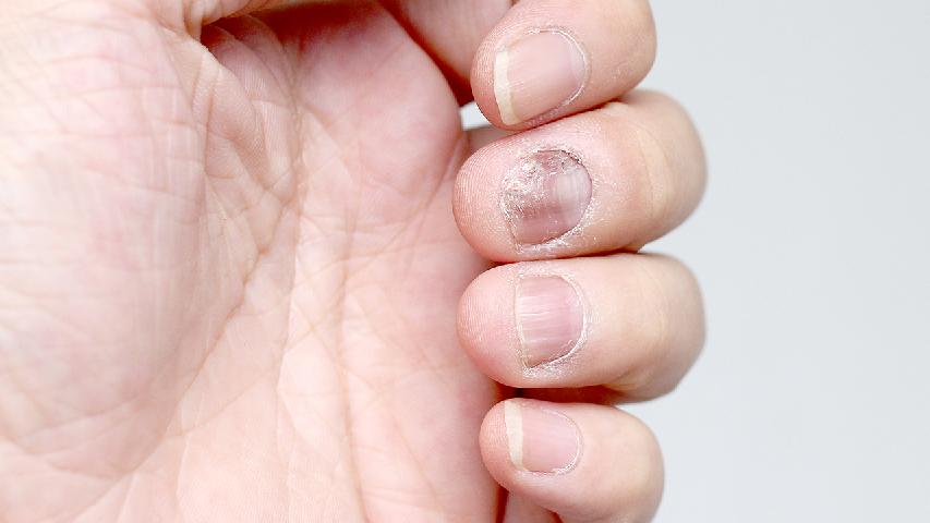 白点灰指甲早期症状