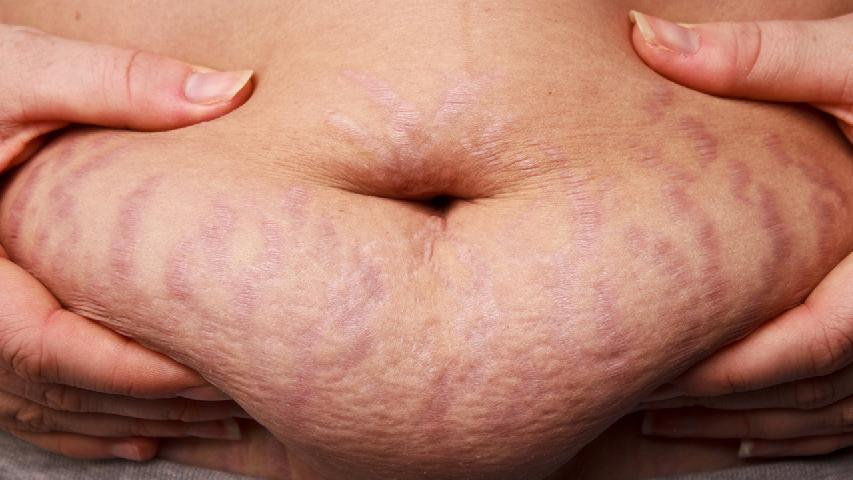 痤疮的症状有哪些