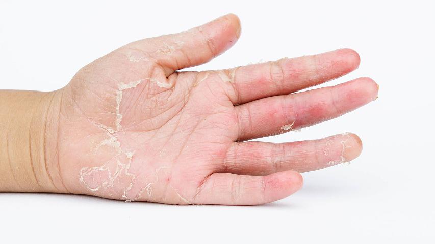 中醫(yī)治療臉部痤瘡的方法有哪些
