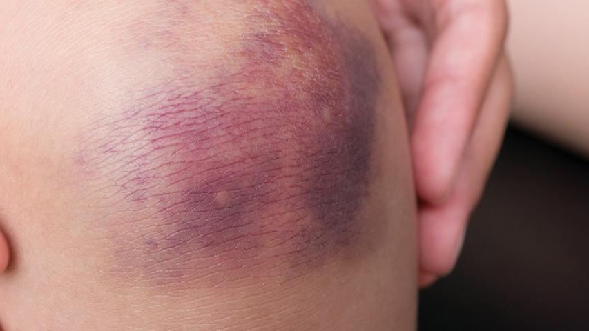 中医治痤疮医院里面都用什么方子