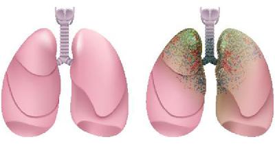 肺气肿的危害有多严重