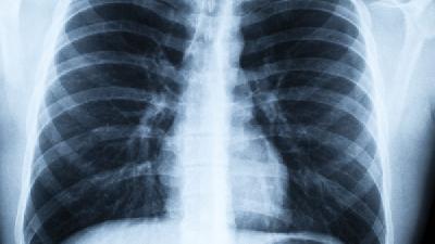 肺纤维化患者的护理措施