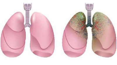 放射性肺纤维化概况