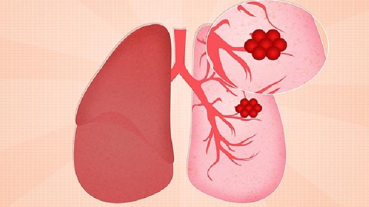 肺纤维化咳血症状