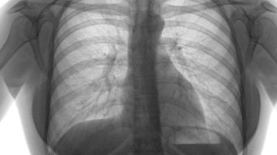 肺纤维化的晚期症状