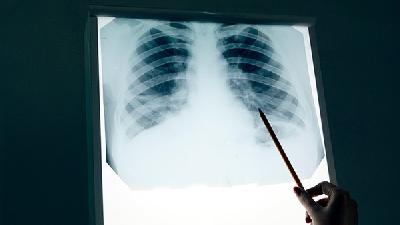 阻塞性肺气肿是否会遗传