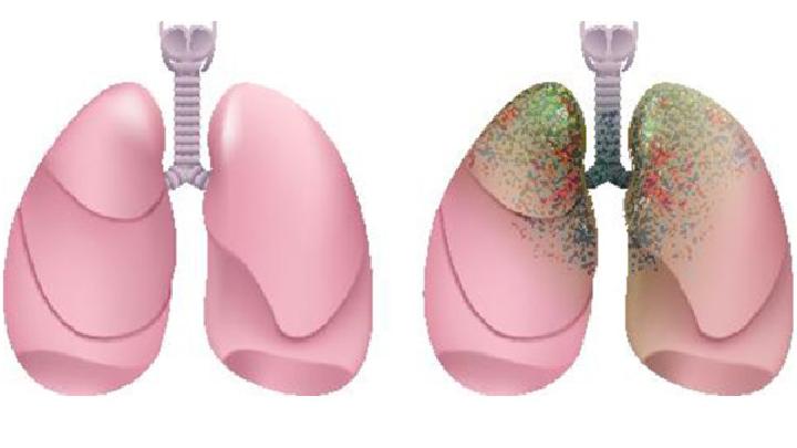 专家为您解析到底什么是肺气肿