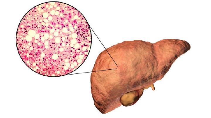 脂肪肝简介
