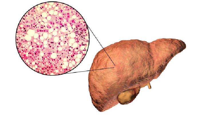脂肪肝是如何形成的呢?