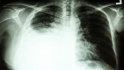 慢阻肺的主要症状有哪些