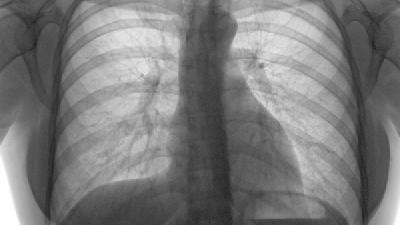肺气肿的x线表现有什么