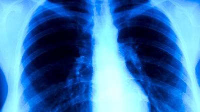 肺纤维化的预防方法
