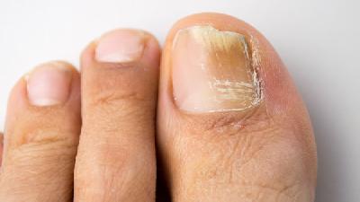 脚趾甲沟炎的鉴别诊断方法有哪些