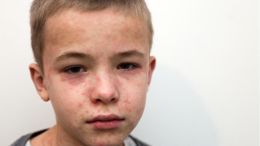 月经少黄褐斑怎么办