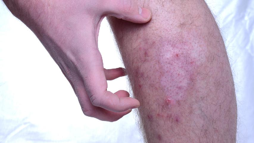 什么是湿疹的皮肤病？