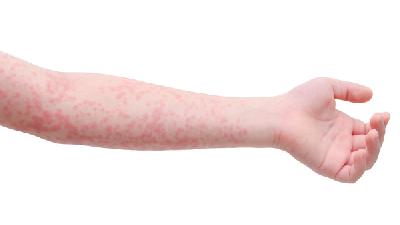 检查荨麻疹常用的一些方法