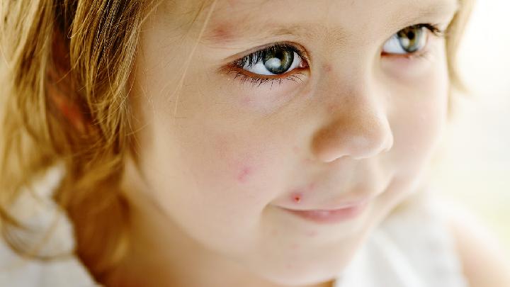 儿童荨麻疹患者该怎么护理？