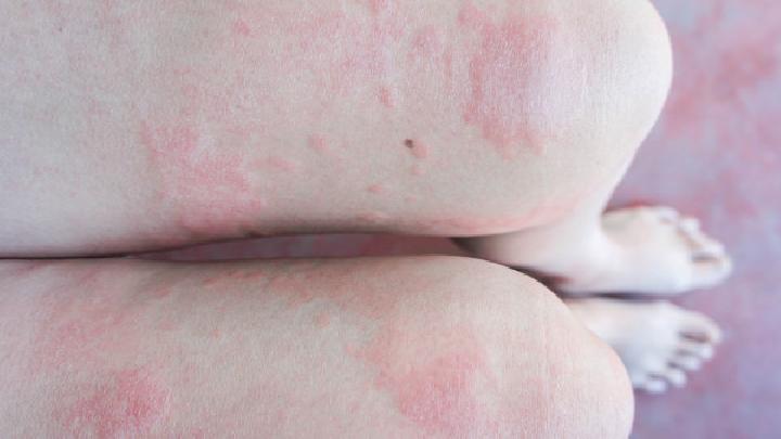 早期皮肌炎对于皮肤的损害