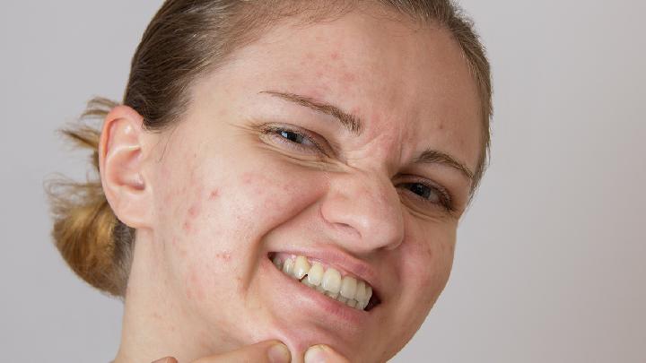 脸上的痘痘让人咬牙切齿学生祛痘方法3天可见效