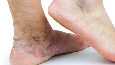 造成半月板损伤有哪些原因