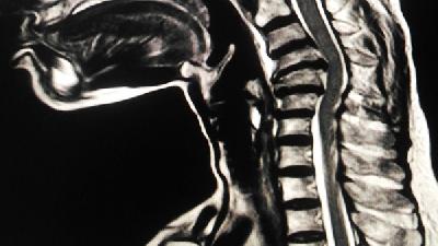 究竟腰肌勞損患者能鍛煉嗎