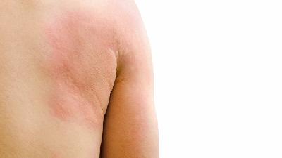 荨麻疹犯了怎么办