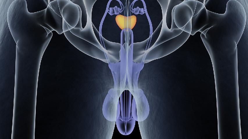 急性细菌性前列腺炎有哪些并发症 前列腺炎小心六大并发症