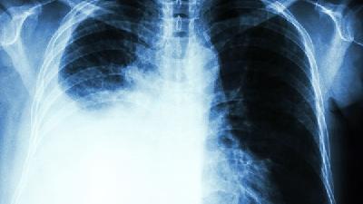 肺纤维化患者的主要症状都有什么