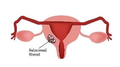 卵巢囊肿怀孕了怎么办