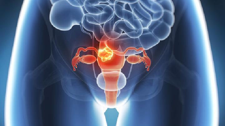 卵巢囊肿的危害有哪些