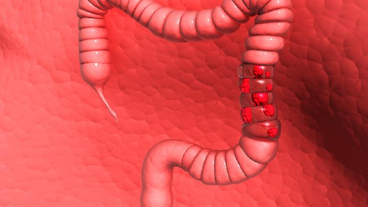 患有結(jié)腸癌化療白細(xì)胞少