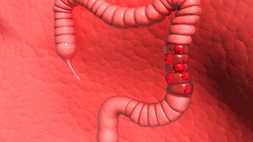 大肠癌影响生理循环