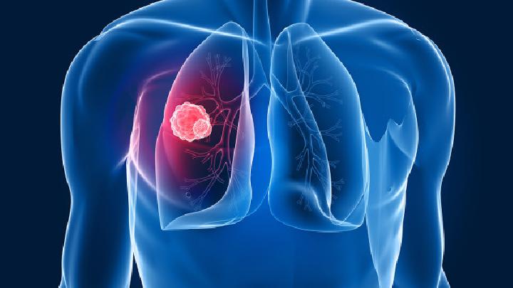 详细介绍肺癌是遗传病吗