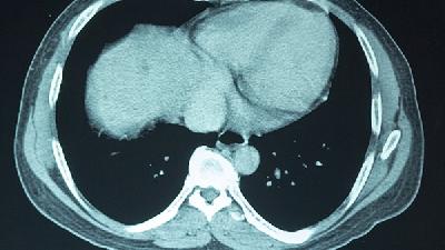 脑癌晚期如何检查