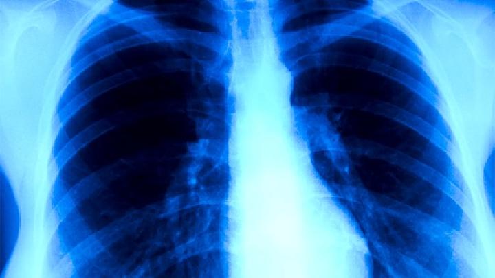 护理肺癌病人传染吗