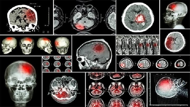 早期脑癌血液检查诊断