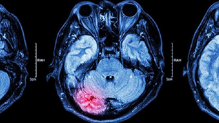 早期脑癌怎样检查得出来