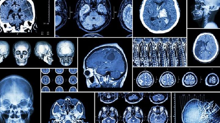 脑癌早期能治愈吗